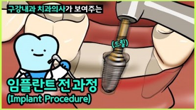 임플란트 가격이 차이 나는 이유와 치과마다 임플란트 치료비용이 다른 이유